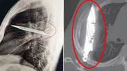 Reprodução/Journal of Surgical Case Reports