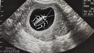 Jovem descobre barata viva em seu intestino - Imagem ilustrativa/Reprodução/Redes sociais